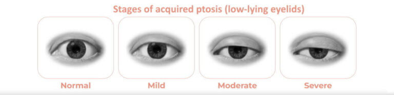 Stages of acquired ptosis | Upneeq | LJ Aesthetics in St. Petersburg, FL